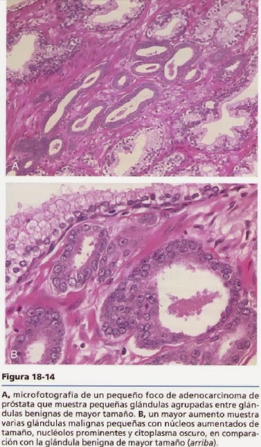 hiperplasia nodular de próstata central hiperplasia nodular de próstata central